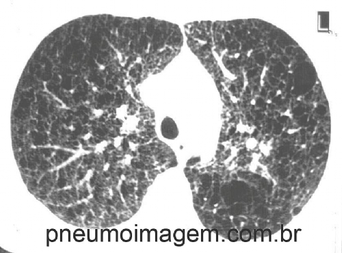 NOVA DROGA APROVADA PELO SUS PARA TRATAR LINFANGIOLEIOMIOMATOSE